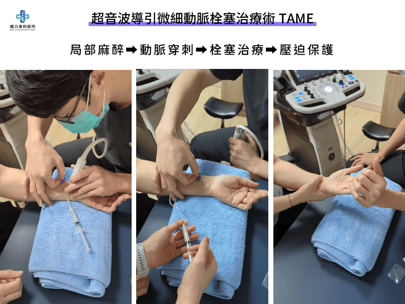 超音波導引微細動脈栓塞治療流程