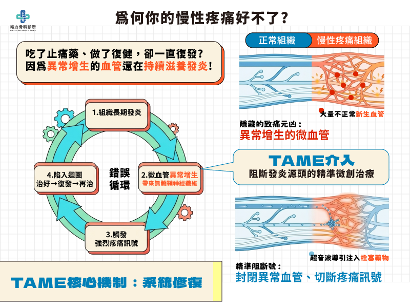 什麼是超音波導引微細動脈栓塞治療術