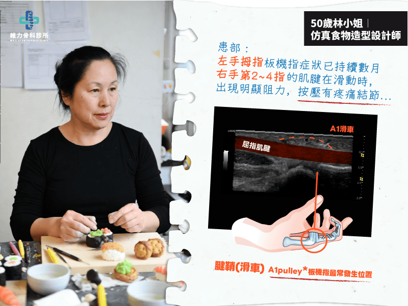 板機指微創手術案例