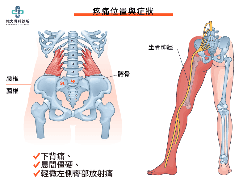 腰椎第五節與薦椎第一節