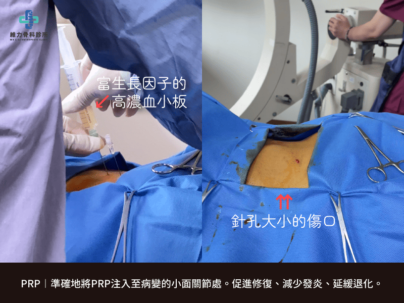腰椎小面關節PRP注射