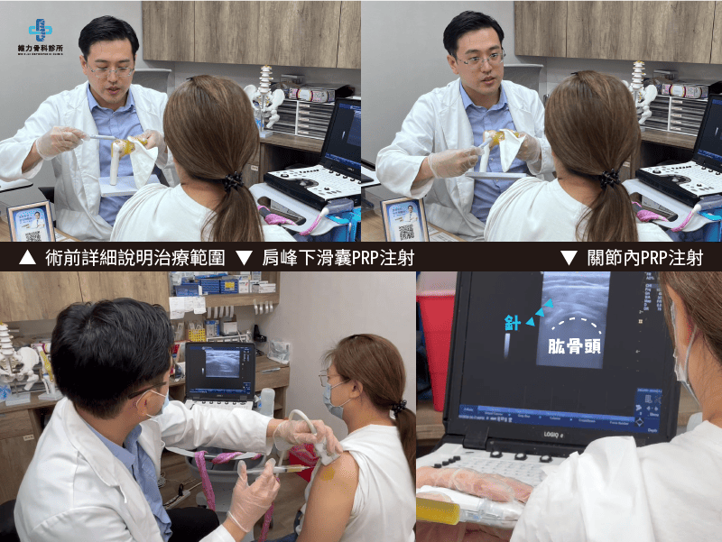 肩膀RPR注射