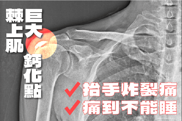 鈣化性肌腱炎案例