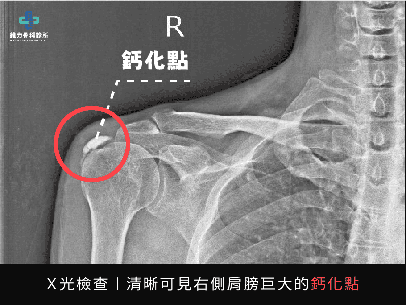 X光檢查清晰可見肩膀巨大的鈣化點