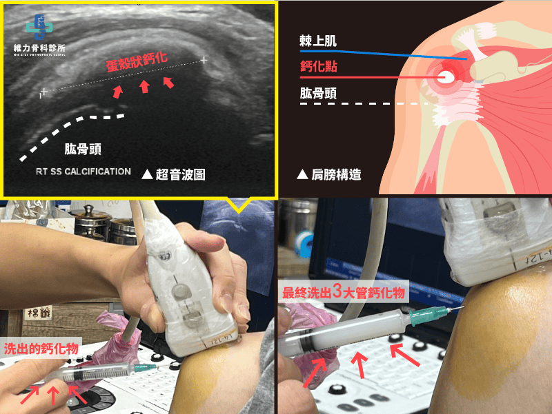 超音波導引抽除鈣化