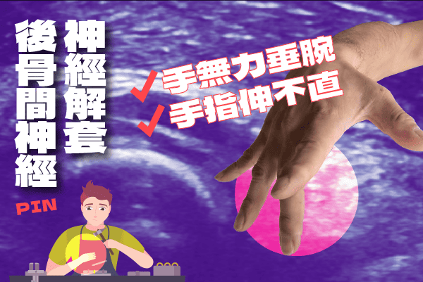 後骨間神經神經解套治療案例