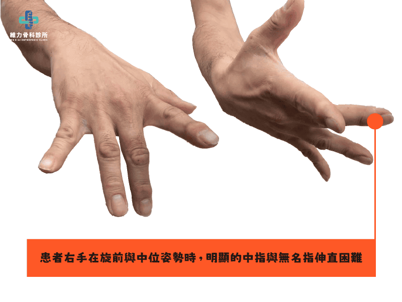 後骨間神經症候群症狀