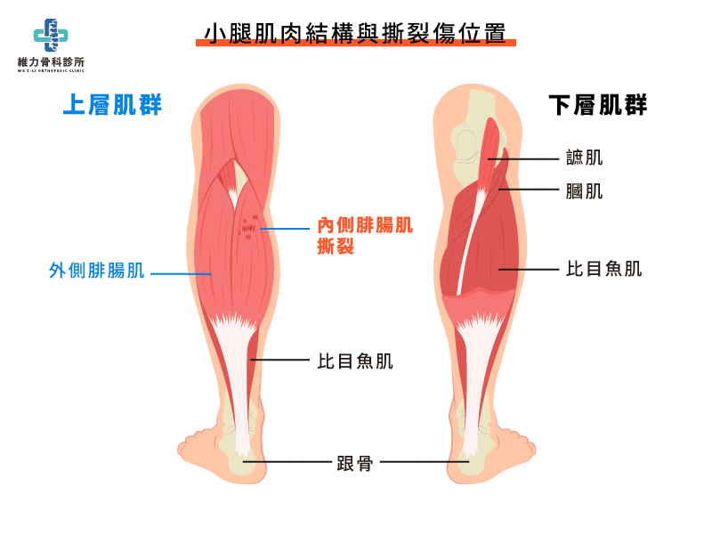 小腿肌肉結構與撕裂傷位置