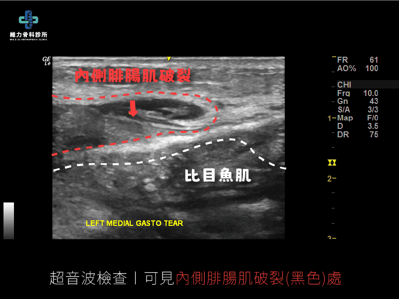 超音波檢查下清楚可見內側腓腸肌破裂