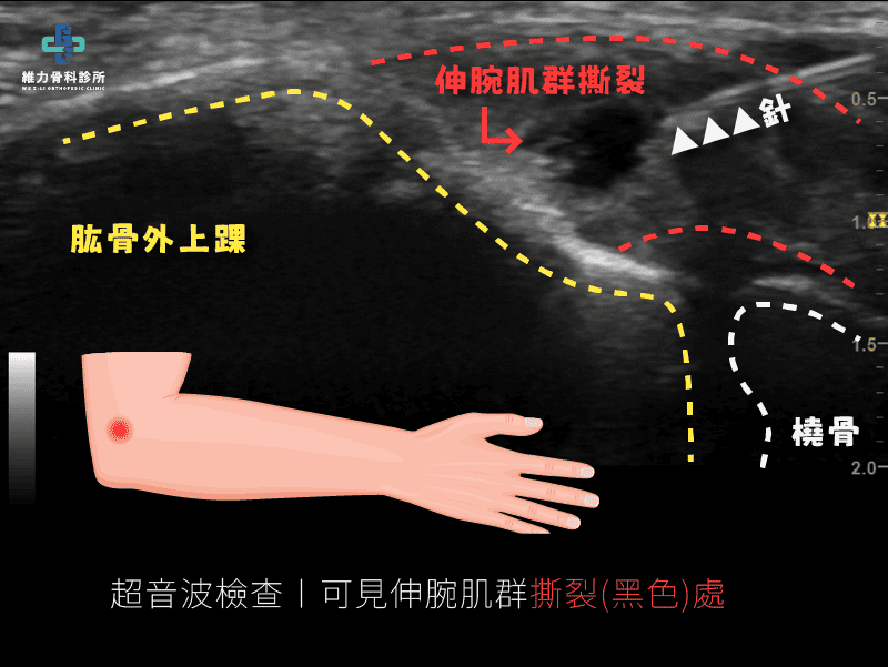 超音波檢查可見伸腕肌群撕裂處