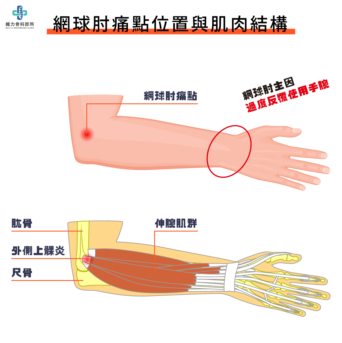 網球肘痛點位置與肌肉結構