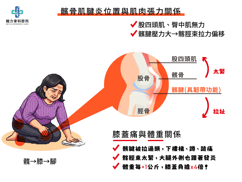 髕骨肌腱炎位置與肌肉張力關係