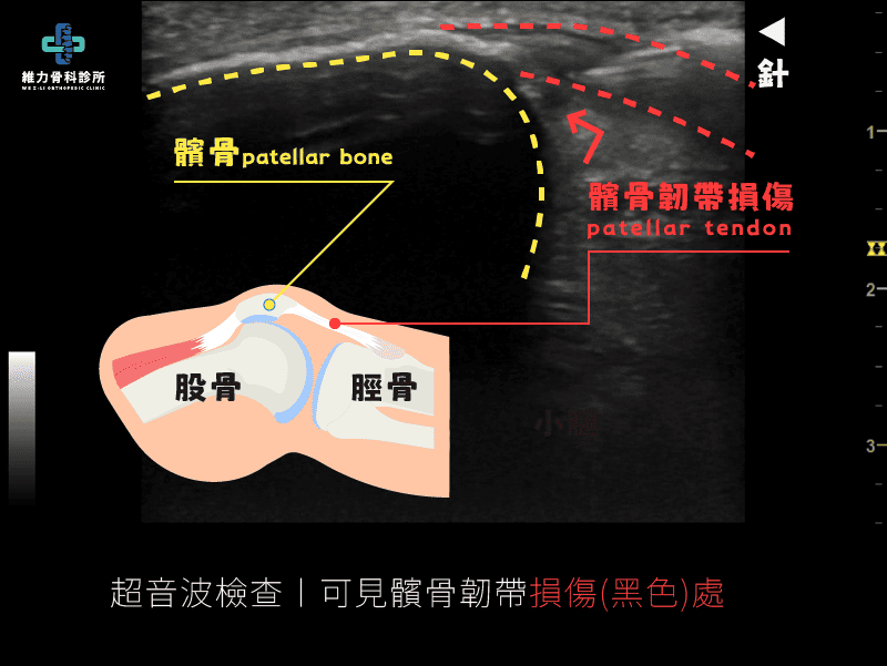 超音波檢查可見髕骨韌帶損傷處