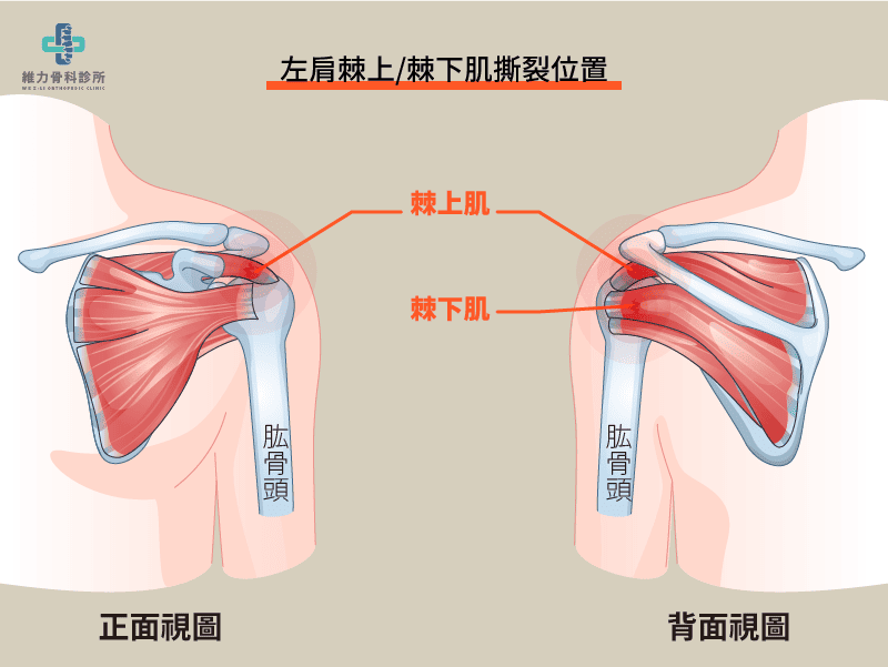 左肩棘上肌、棘下肌撕裂位置