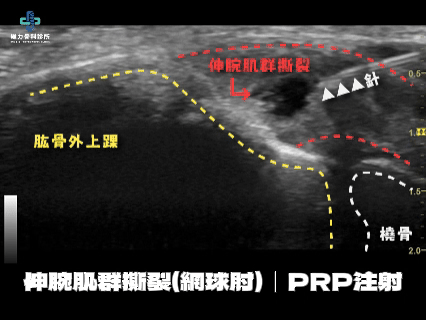 網球肘PRP注射