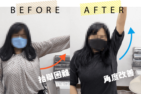 肩關節擴張術案例