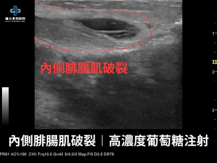 腓腸肌撕裂超音波導引下高濃度葡萄糖注射