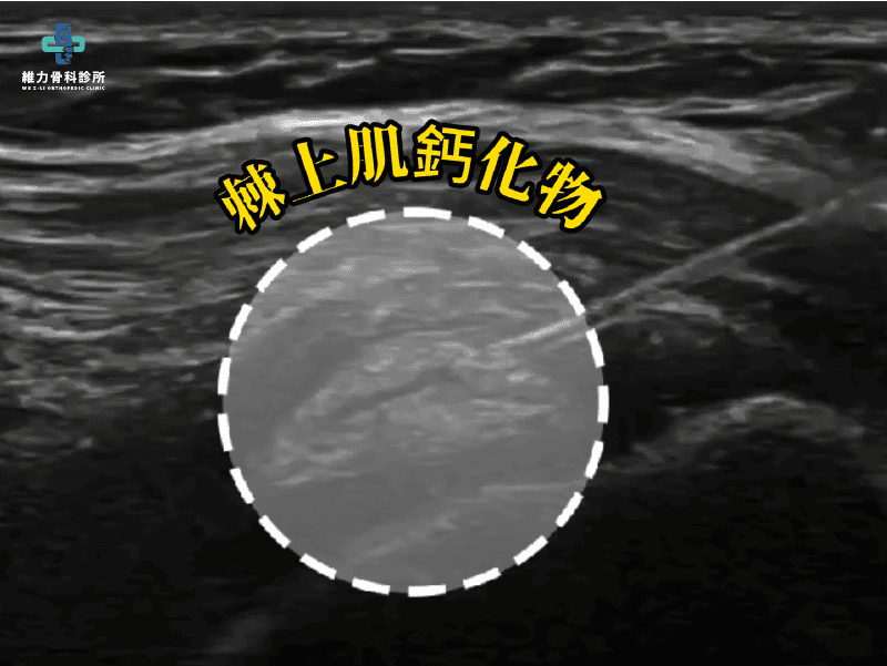 超音波影像檢查可視肌腱上的鈣化點