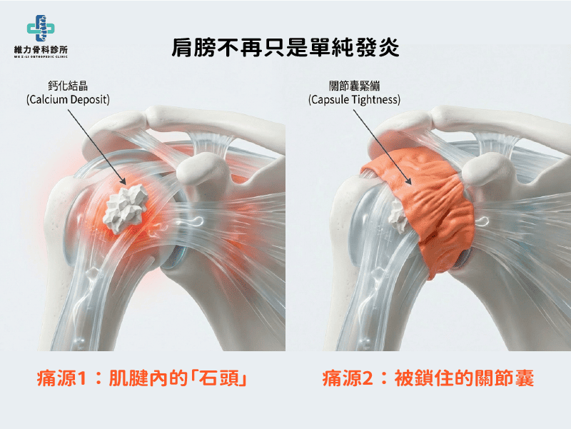 非單一痛源的肩膀痛