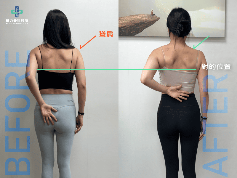 阻斷+擴張術後變化