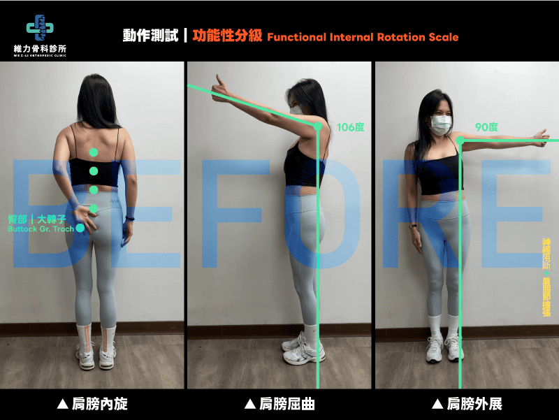 治療前進行動作測試，肩膀角度受限的狀態
