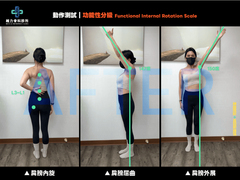 治療後進行動作測試，肩膀角度恢復的狀態