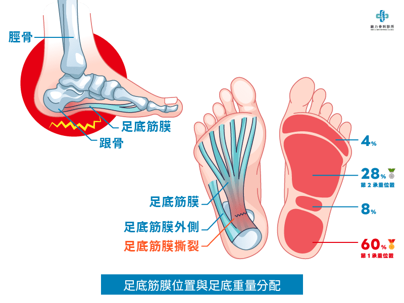 什麼是足底筋膜炎