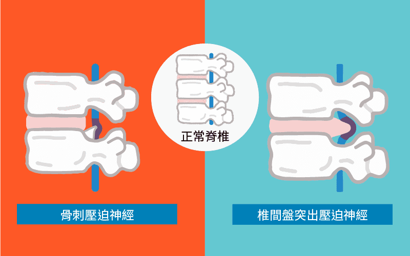 骨刺不是椎間盤突出