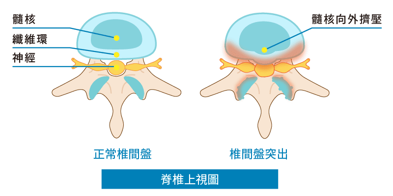 椎間盤突出