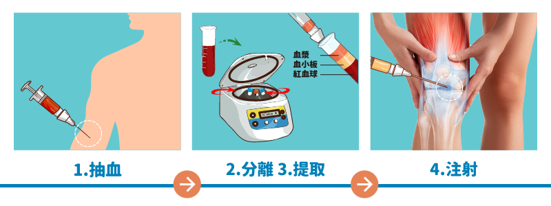 PRP進行方式