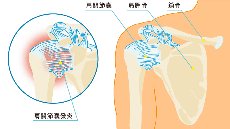 五十肩