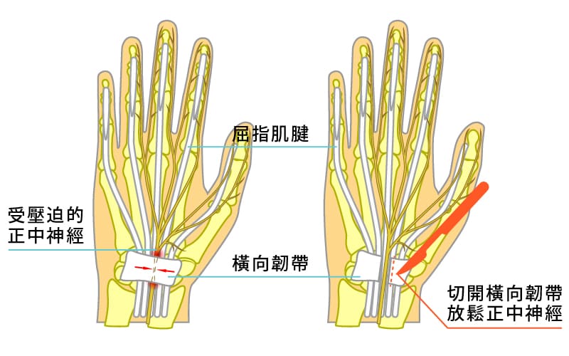 手術示意圖