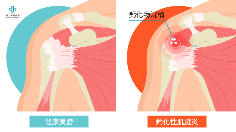 什麼是鈣化性肌腱炎