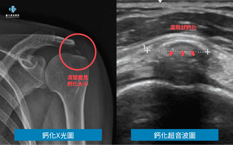 鈣化性肌腱炎X光與超音波