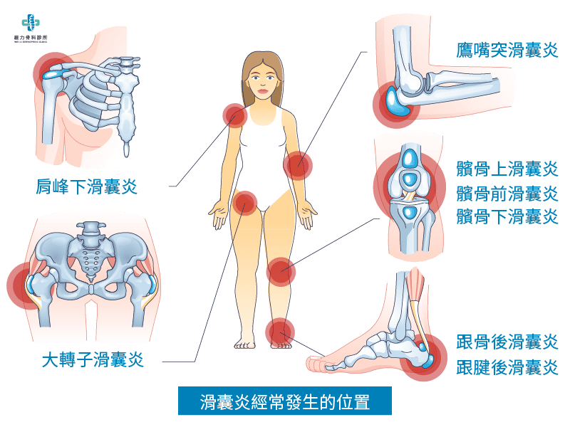 滑囊炎經常發生的位置