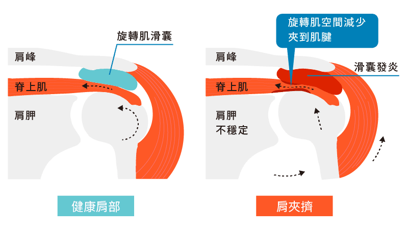 什麼是肩夾擠症候群