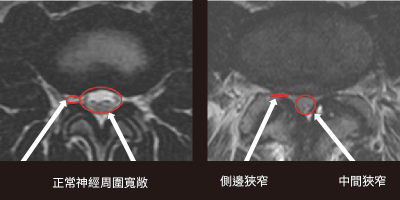 脊椎狹窄X光