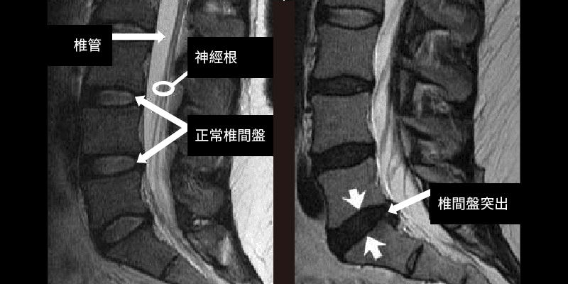 脊椎狹窄症原因