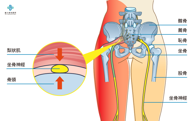 什麼是梨狀肌症候群