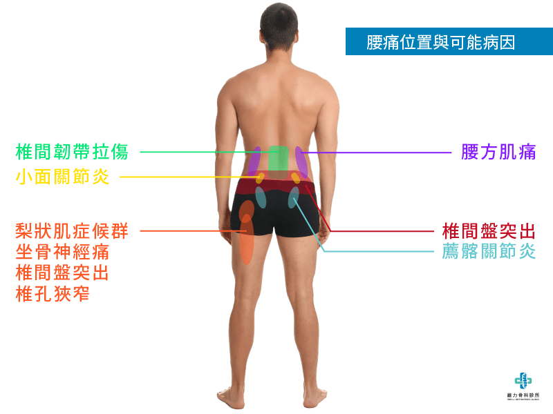 腰痛位置與可能病因