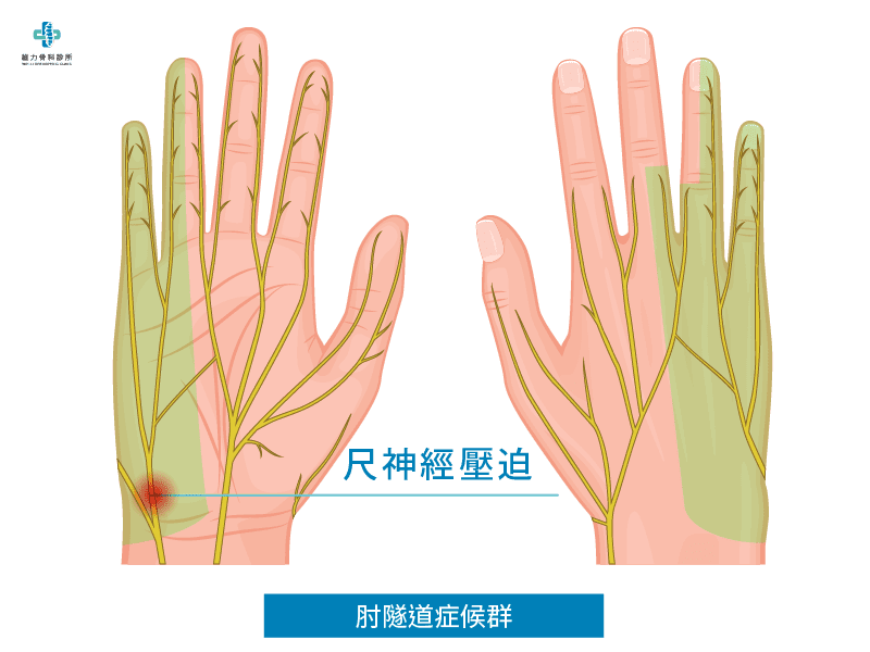 什麼是肘隧道症候群