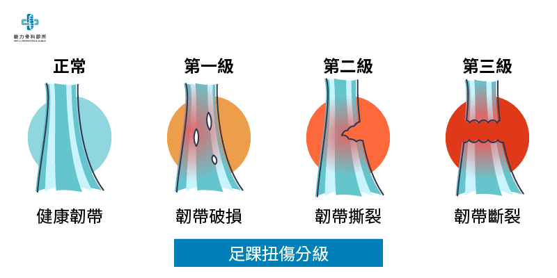 0zuhuainiushang_2.png 足踝扭傷分級