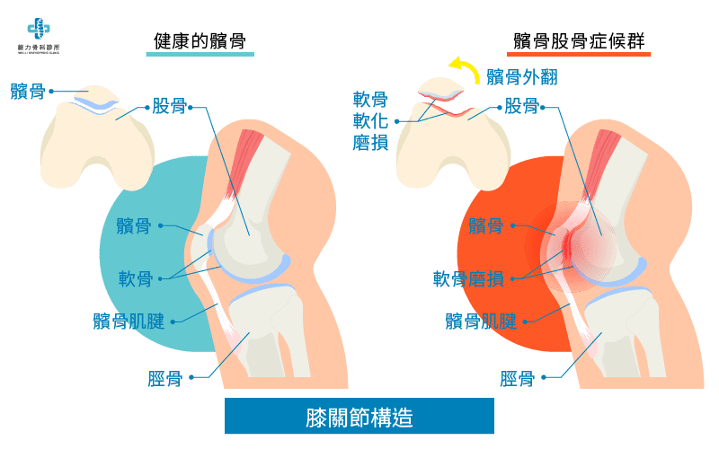 什麼是髕骨股骨症候群