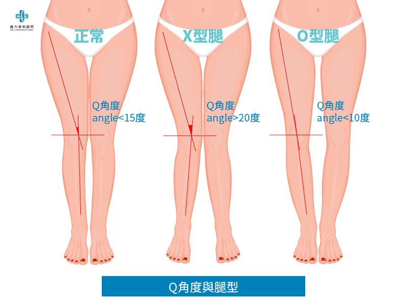 Q角度與腿型