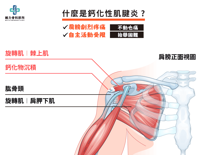 什麼是鈣化性肌腱炎