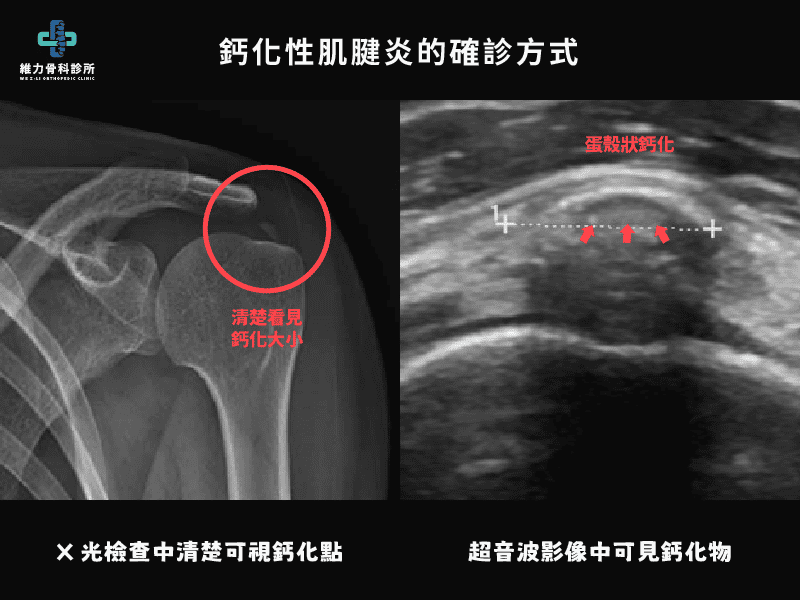 鈣化性肌腱炎的檢查X光或超音波確診