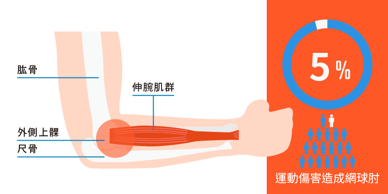 11網球肘_1.png 什麼是網球肘