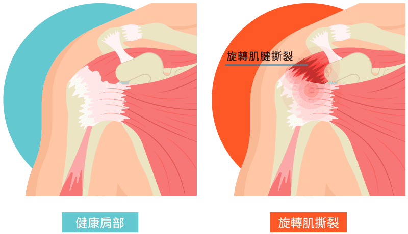 旋轉肌袖症候群