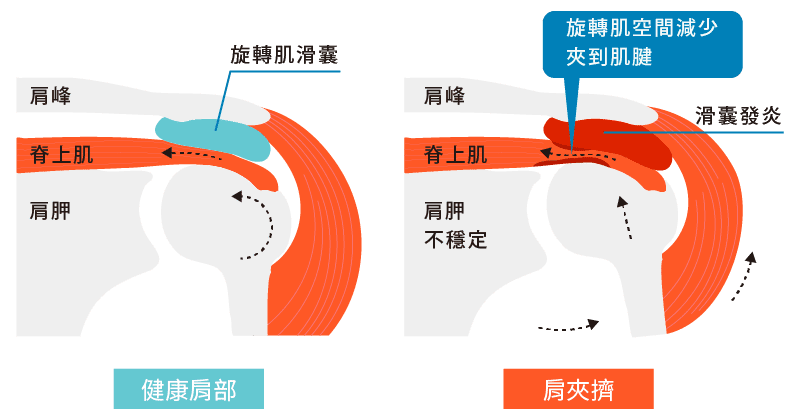 肩夾擠症候群