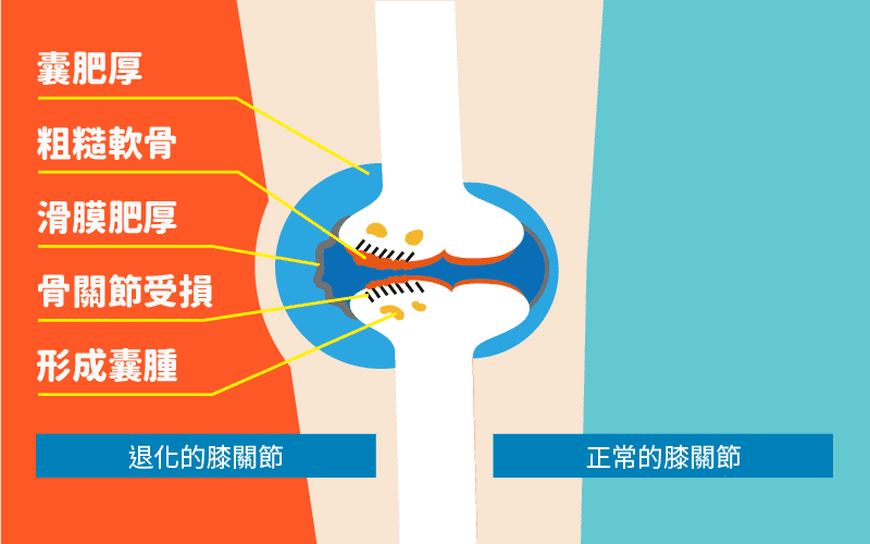 13膝關節退化_1.png 膝關節退化